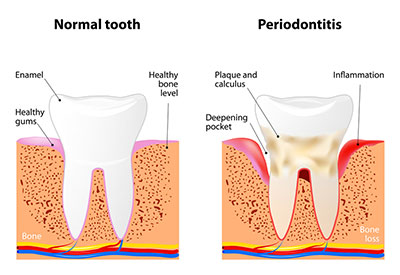 Periodontitis in Waco,Tx